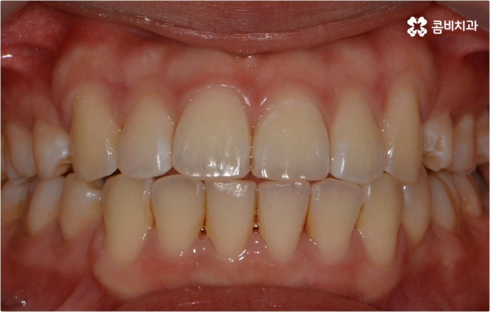 돌출입 치아교정 부모와 아이가 함께 알아봐요 관련 이미지 13