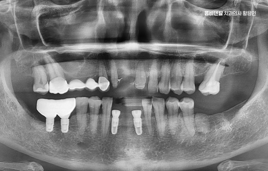 임플란트의 장점 할까 말까 고민이신 분들을 위한 정리 관련 이미지 7