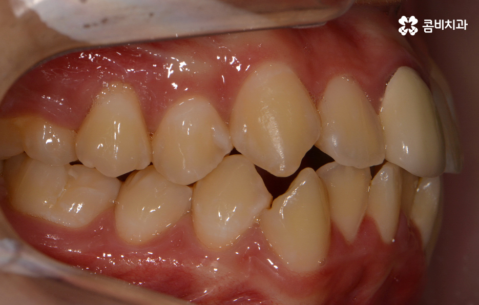 덧니교정 불편함이 느껴지지 않더라도 관련 이미지 2