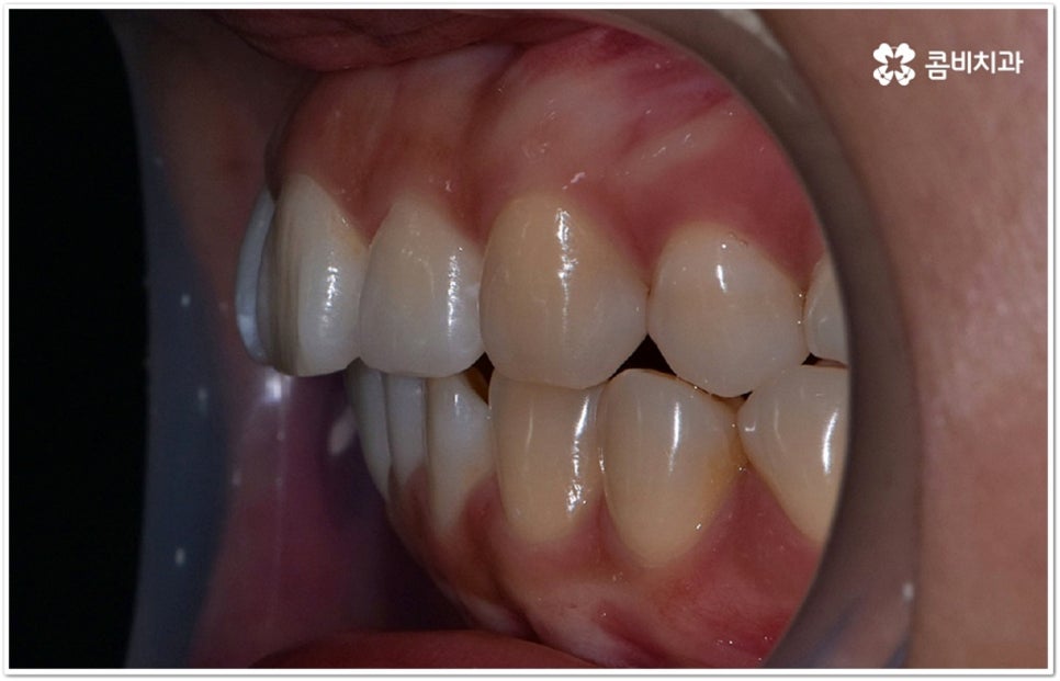 덧니부분교정 시작하려면 관련 이미지 6