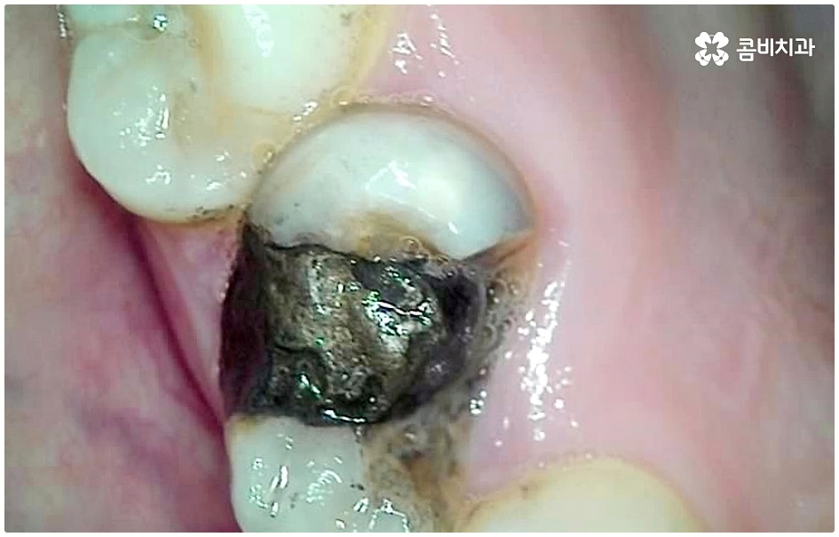 명동치과 평소에 케어하기 관련 이미지 1