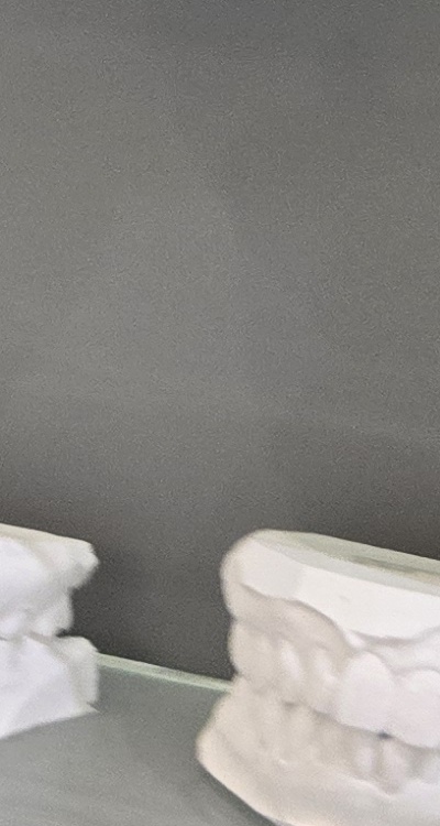 윗니 전체 임플란트 뭐부터 해야할까 관련 이미지 35