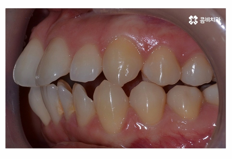 치아부분교정 나도 해당될지 궁금하다면 관련 이미지 2