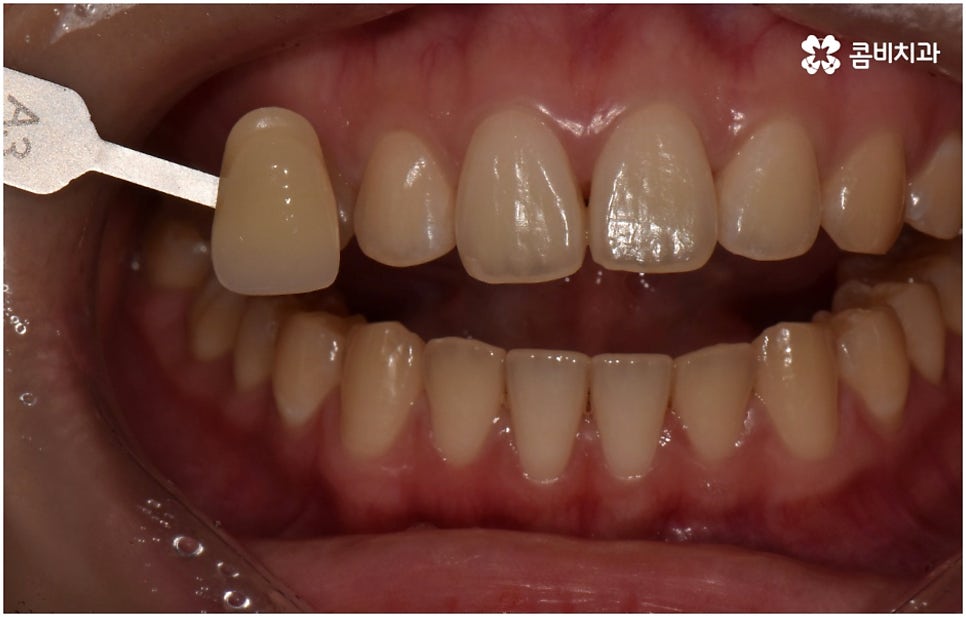 누런치아 하얗게 바꾸고 싶다면 관련 이미지 1