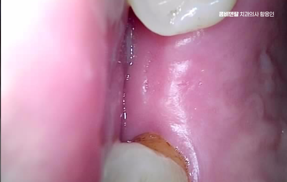 어금니 없으면 얼굴 발음에 어느정도나 안좋을까 관련 이미지 4