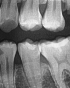 어금니 뒤 잇몸 부음 어떤 문제길래 이런거죠 관련 이미지 34