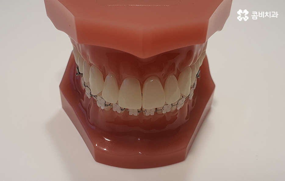 콤비교정 나에게 적합한지 판단하려면 관련 이미지 1