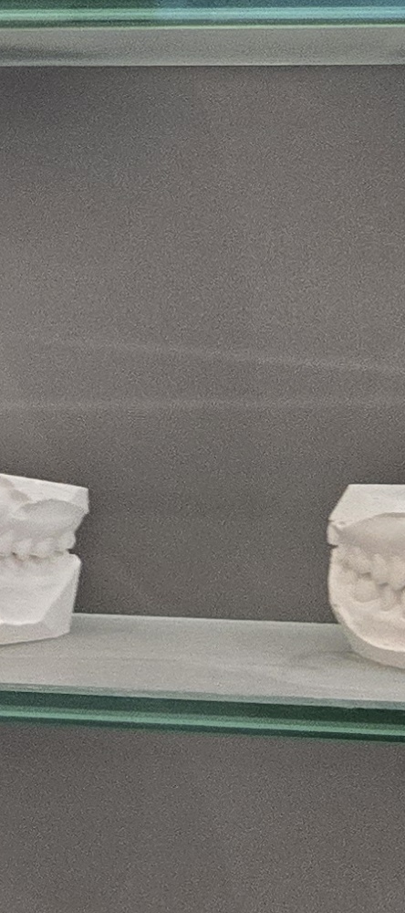 앞이빨 임플란트 과정 주의해야할 포인트는 관련 이미지 23