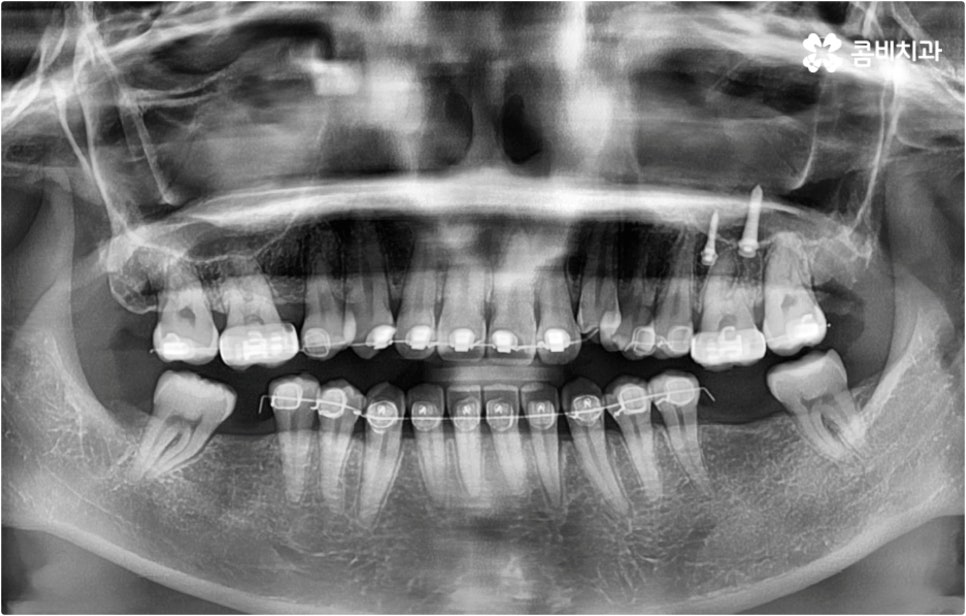 치아설측교정 보이지않아 좋아요 관련 이미지 11