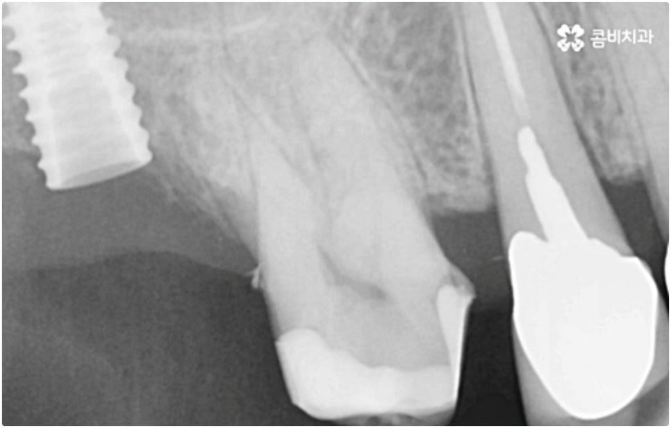 어금니임플란트 살펴볼 사항들은 무엇인가요? 관련 이미지 9