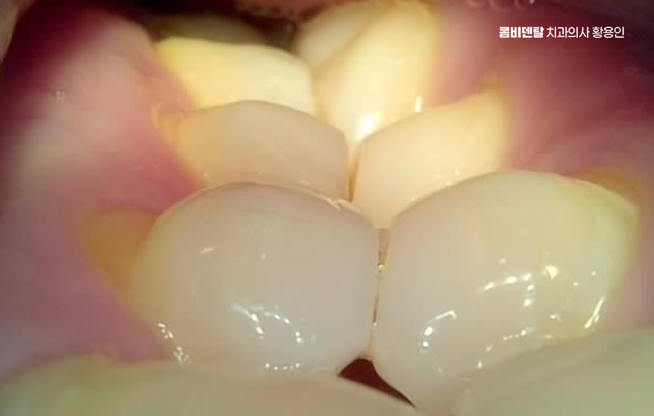 사랑니 주변 잇몸 통증 지금부터가 중요하니까 관련 이미지 8