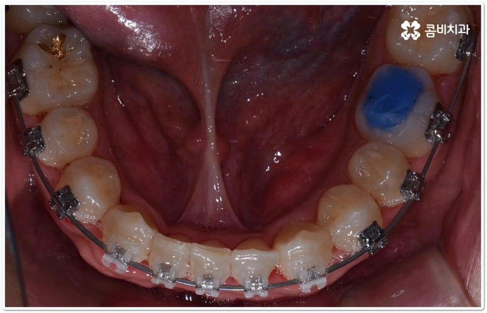 클리피씨교정 합리적인 초이스! 관련 이미지 11