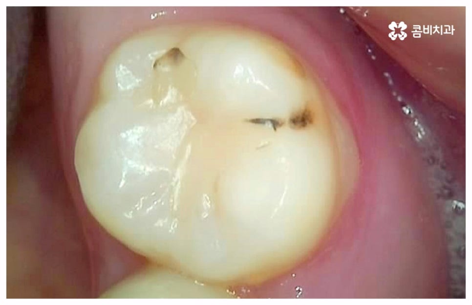 치통이 심할때 어떻게 해야하나요 관련 이미지 1