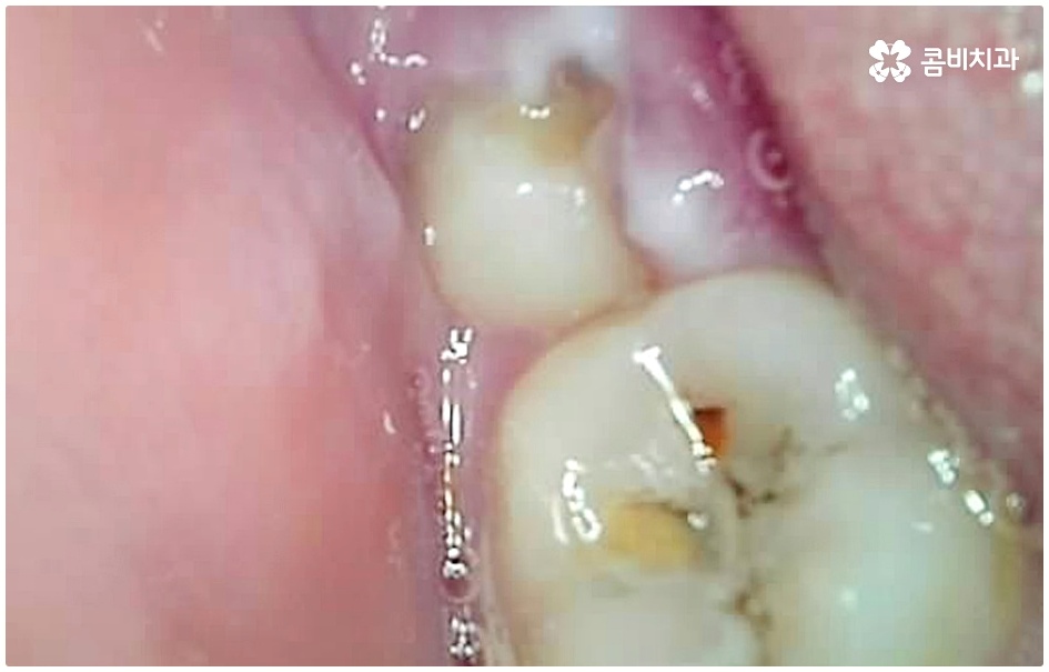 명동치과 평소에 케어하기 관련 이미지 4