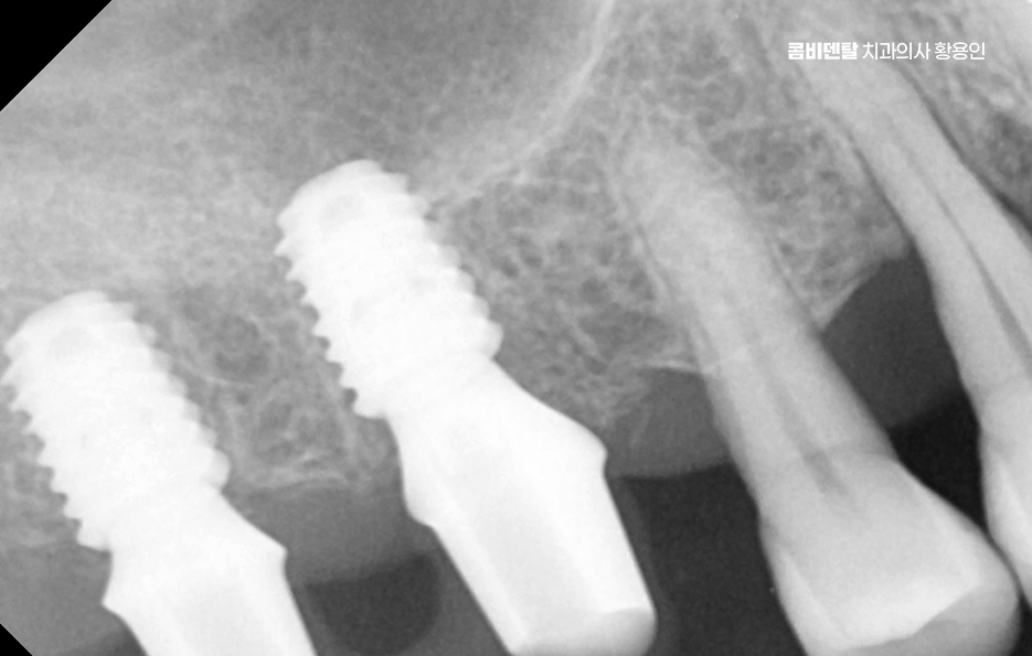 임플란트 뼈이식 안하면 어떤 문제가 있는거죠 관련 이미지 9