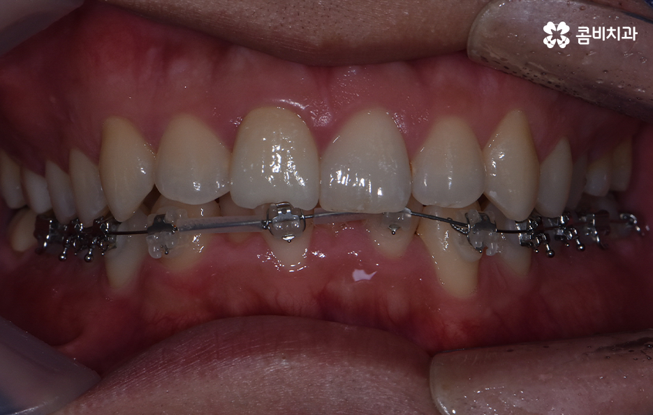 아랫니교정 이렇게만 파악하시면 됩니다 관련 이미지 8