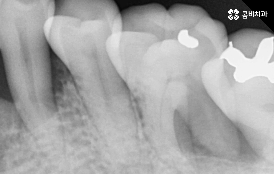 치아 옆면 충치 이렇게 무섭습니다 관련 이미지 5