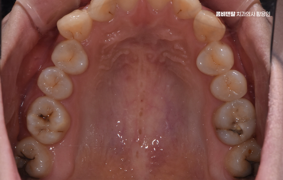 신경치료 아픈가요 망설이시는 분들이라면 관련 이미지 2