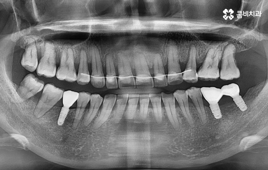 임플란트 해야 하는데 치아교정이 하고 싶다면 관련 이미지 12