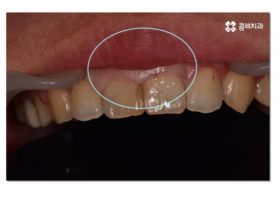 치주질환 치료의 중요성과 치은절제술이 활용된 사례 관련 이미지 2