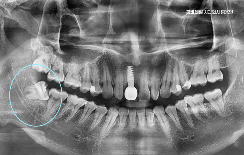 사랑니 발치 후 충치 치료 둘다 준비하려면 관련 이미지 1