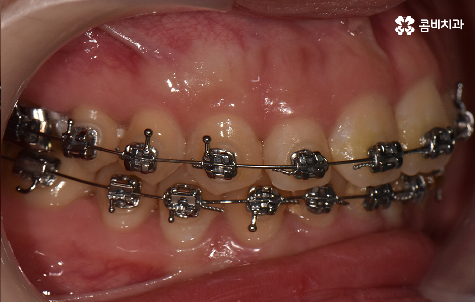 앞니 틀어짐 교정으로 해결하면 될까요 관련 이미지 8