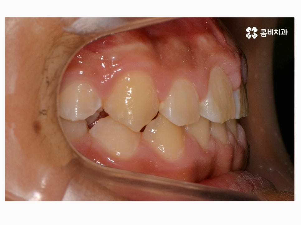 과개교합교정 어릴때 고쳐주면 좋은 사례 관련 이미지 14