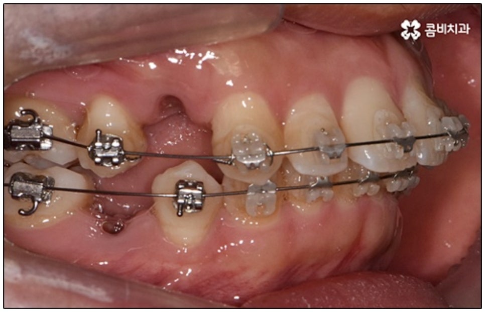 클리피씨교정 알아봐야 할것들 관련 이미지 4