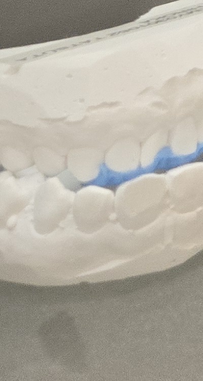 앞니 틀어짐 부분교정 얼마나 걸릴까 관련 이미지 43