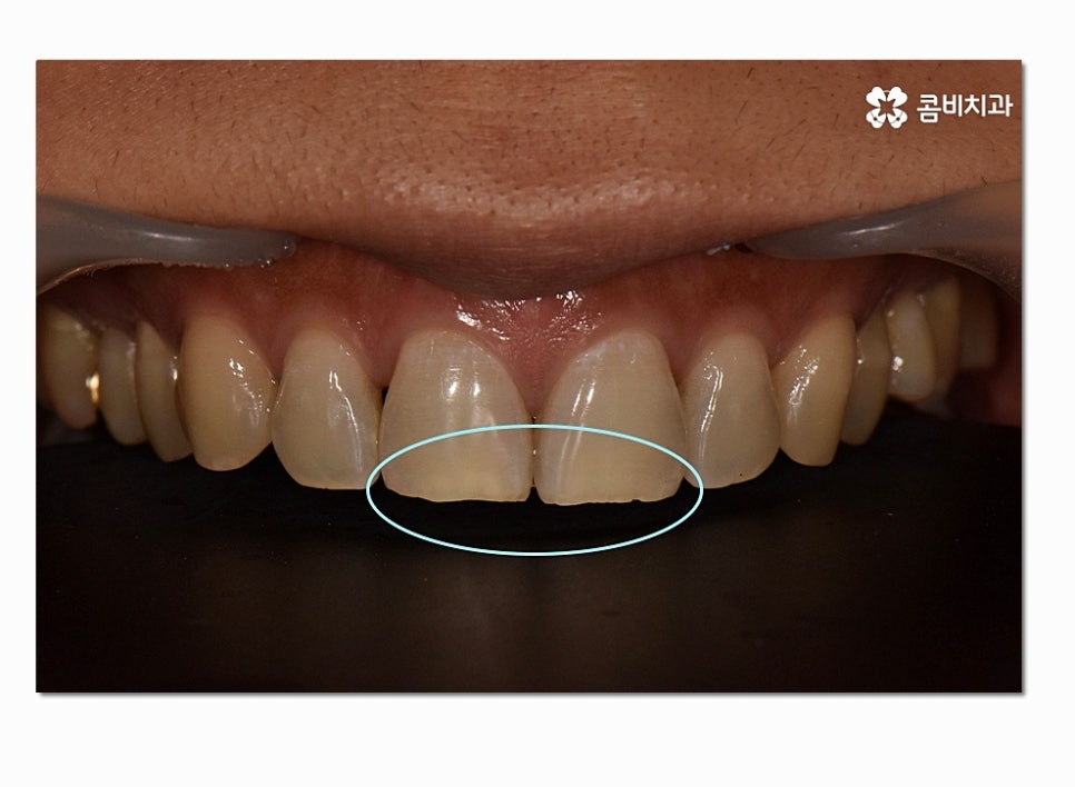 치아라미네이트 누구에게 필요할지 궁금하다면 관련 이미지 2