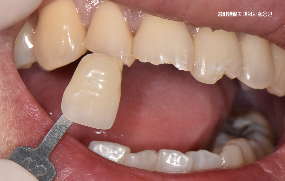 How to Use Laminate Veneers for Chipped Front Teeth image 3