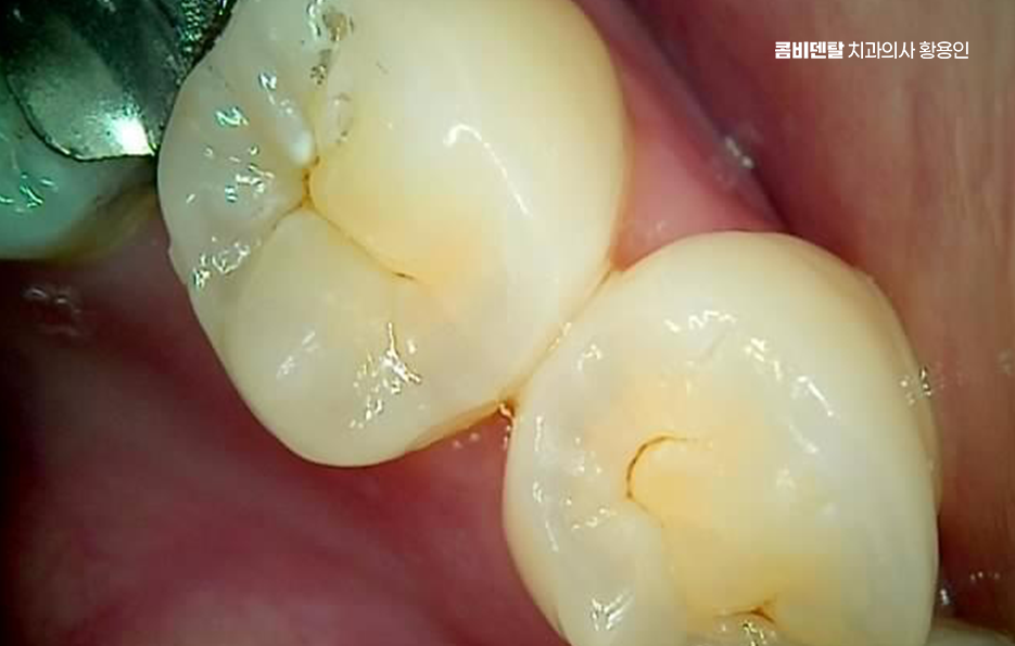 아말감 교체 레진 인레이 어떻게 대처하면 될까 관련 이미지 4