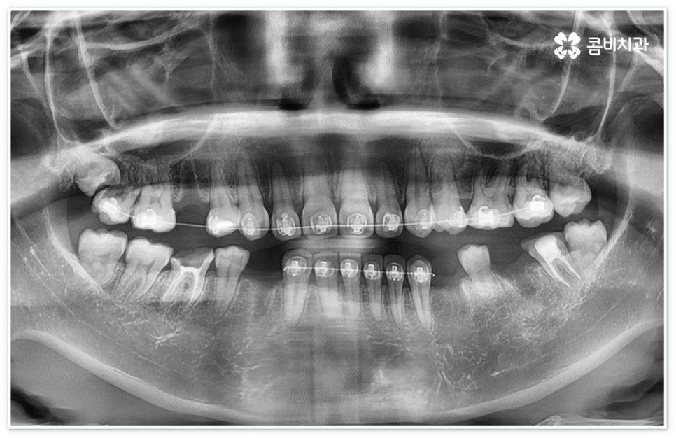 신경치료통증 무섭다고 미루면 관련 이미지 10