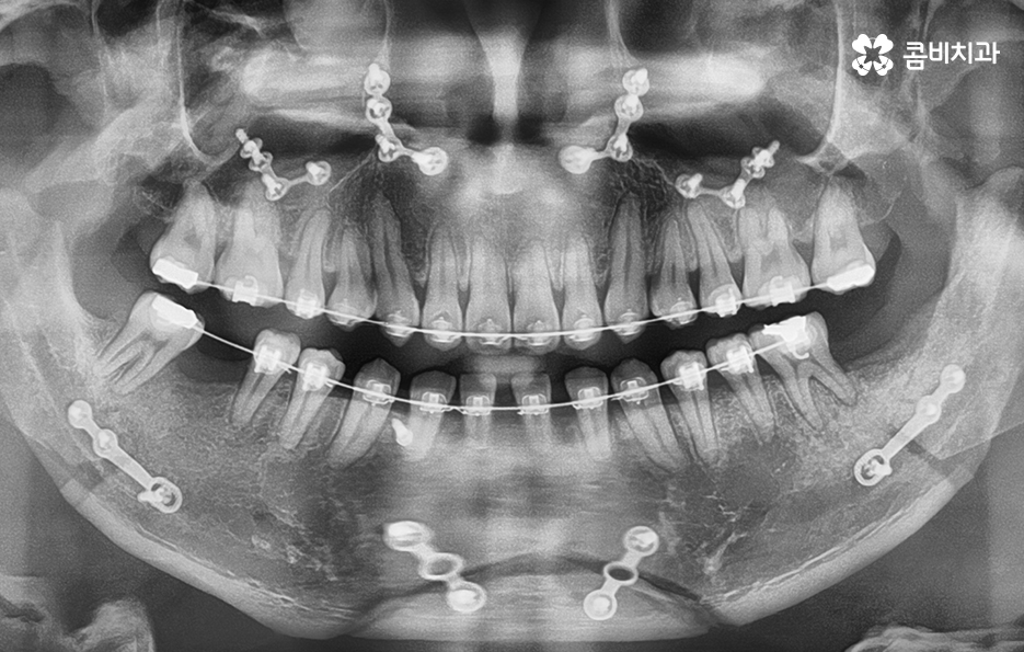 클리피씨교정 늦지않게 결정하려면 관련 이미지 11