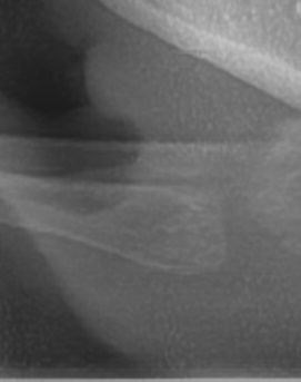어금니 뒤 잇몸 부음 어떤 문제길래 이런거죠 관련 이미지 39