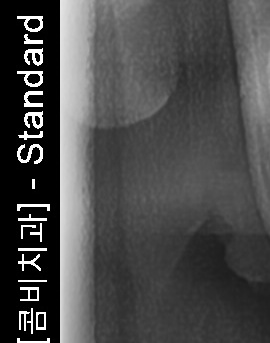 어금니 뒤 잇몸 부음 어떤 문제길래 이런거죠 관련 이미지 28