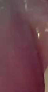 잇몸 고름주머니 방치 늦지않게 대처하려면 관련 이미지 24