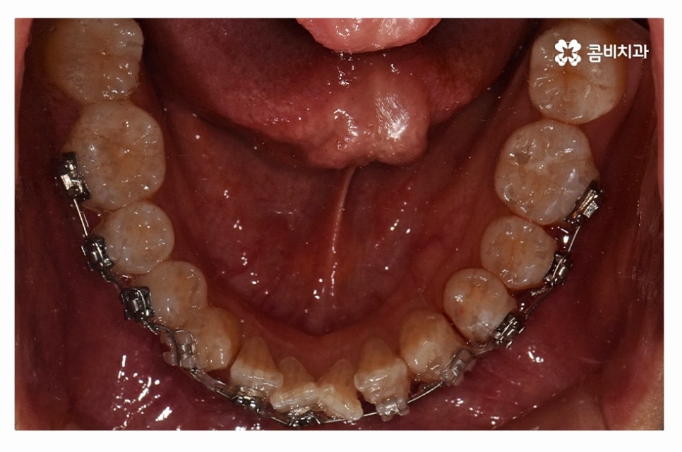 덧니교정 체계적으로 준비하려면 관련 이미지 8
