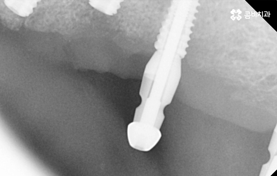 임플란트 나이 얼마나 영향을 줄까 관련 이미지 6