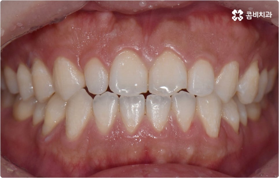 치아미백시술 관심있다면 관련 이미지 3