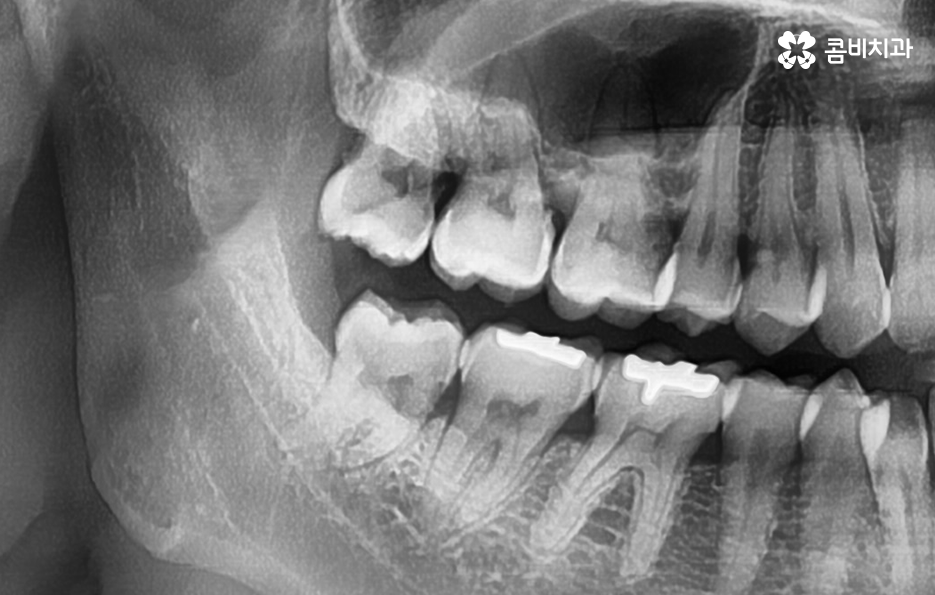 매복사랑니 냄새 방치하면 이런 문제도 생겨요 관련 이미지 3