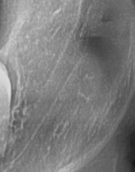 어금니 뒤 잇몸 부음 어떤 문제길래 이런거죠 관련 이미지 36