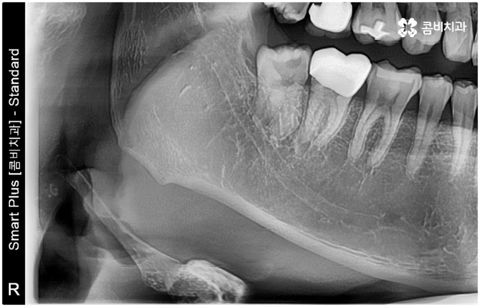 매복사랑니발치치과 어디로 가나요? 관련 이미지 5