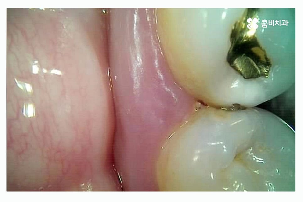 충치 레진 인레이 합리적으로 결정하려면 관련 이미지 8