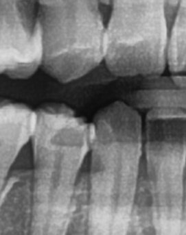 어금니 뒤 잇몸 부음 어떤 문제길래 이런거죠 관련 이미지 32