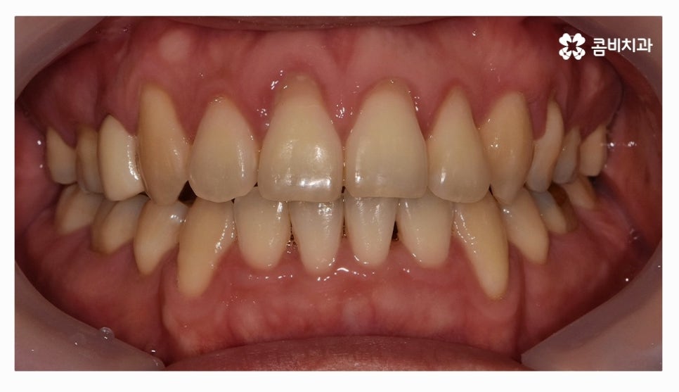 클리피씨교정 올바르게 판단하려면 관련 이미지 13
