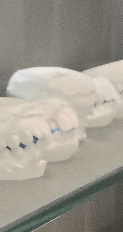 앞니 틀어짐 부분교정 얼마나 걸릴까 관련 이미지 38