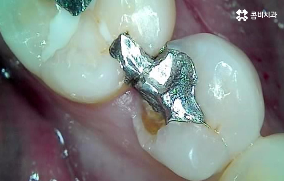 어금니 충치 깨짐 판단기준부터 세워보세요 관련 이미지 12