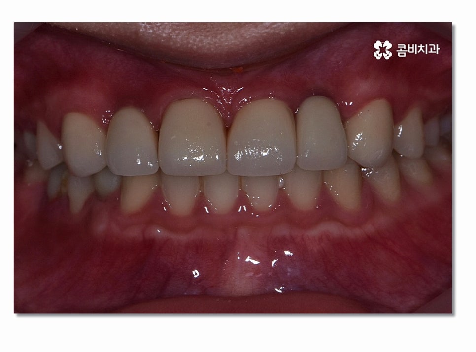 앞니임플란트 합리적으로 접근하려면 관련 이미지 8