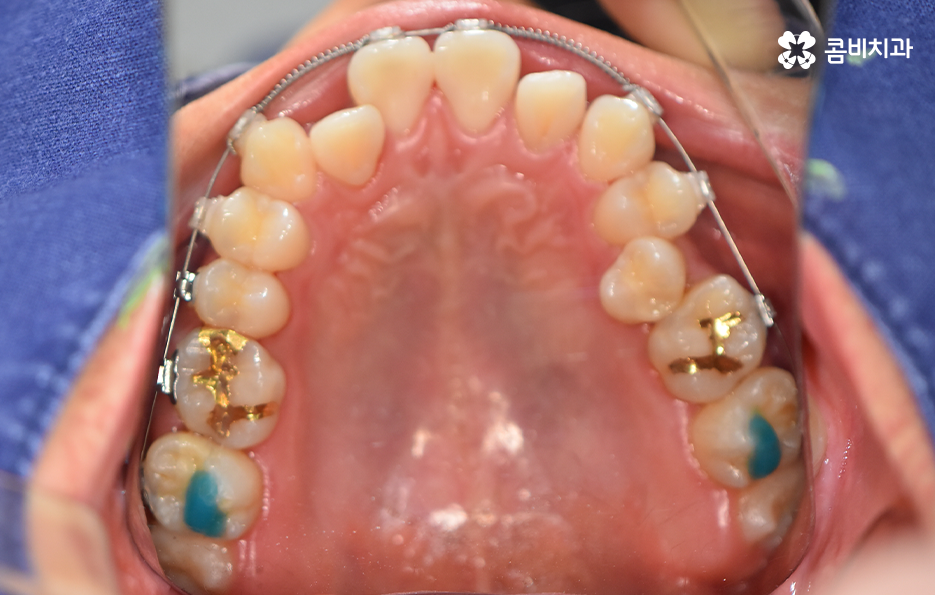 30대 치아교정 빨리 끝내고 싶어요 관련 이미지 11